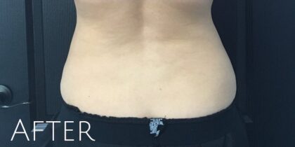 CoolSculpting Before & After Patient #410