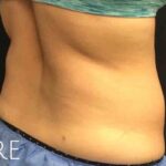 CoolSculpting Before & After Patient #413