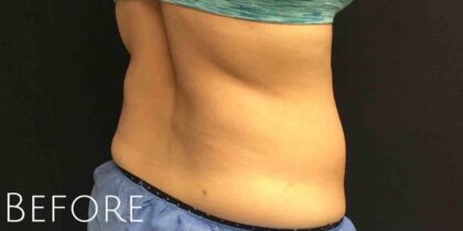 CoolSculpting Before & After Patient #413