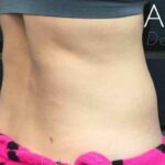 CoolSculpting Before & After Patient #413