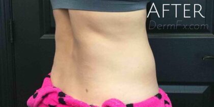 CoolSculpting Before & After Patient #413