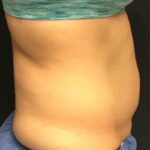 CoolSculpting Before & After Patient #413