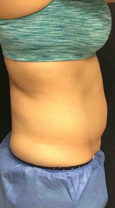 CoolSculpting Before & After Patient #413