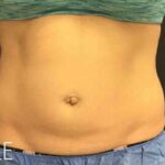 CoolSculpting Before & After Patient #413