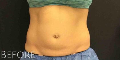 CoolSculpting Before & After Patient #413