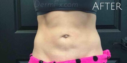 CoolSculpting Before & After Patient #413