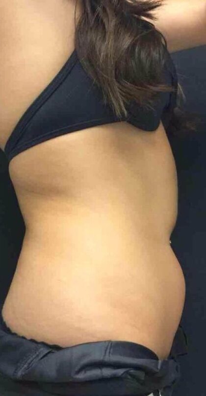 CoolSculpting Before & After Patient #420