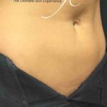 CoolSculpting Before & After Patient #423