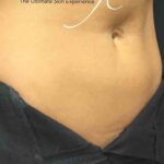 CoolSculpting Before & After Patient #423