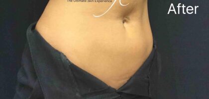 CoolSculpting Before & After Patient #423