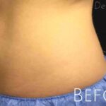 CoolSculpting Before & After Patient #426