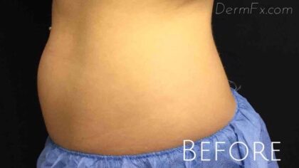 CoolSculpting Before & After Patient #426