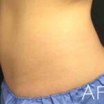 CoolSculpting Before & After Patient #426