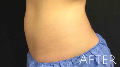 CoolSculpting Before & After Patient #426