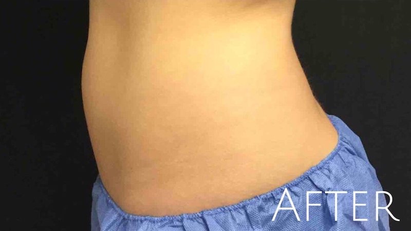 CoolSculpting Before & After Patient #426