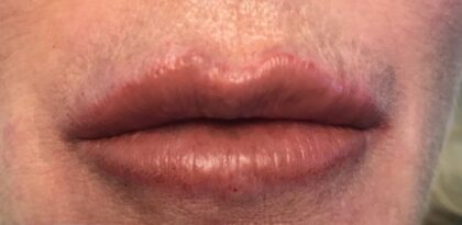 Lip Injections Before & After Patient #468