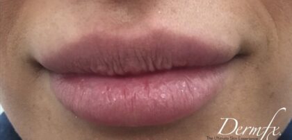 Lip Injections Before & After Patient #441