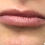Lip Injections Before & After Patient #472