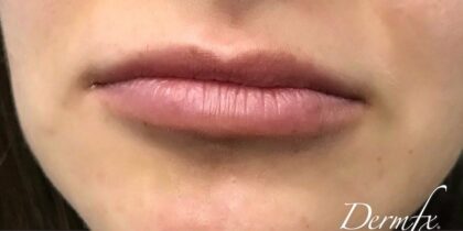 Lip Injections Before & After Patient #472