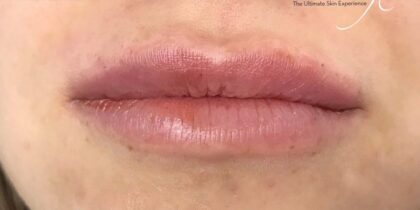 Lip Injections Before & After Patient #472