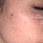 IPL Photofacial Before & After Patient #447