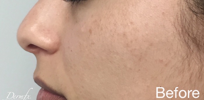 IPL Photofacial Before & After Patient #872