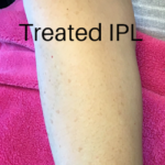 IPL Photofacial Before & After Patient #875