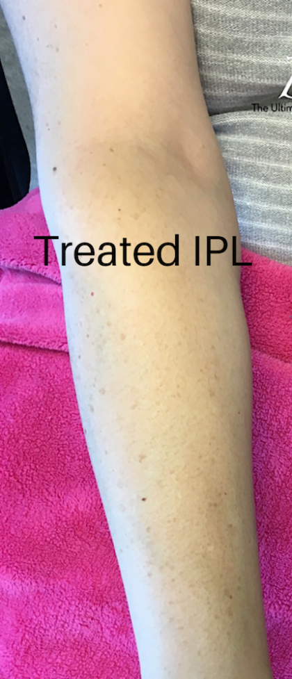 IPL Photofacial Before & After Patient #875