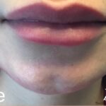 Lip Injections Before & After Patient #486