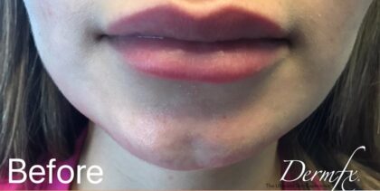 Lip Injections Before & After Patient #486