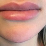 Lip Injections Before & After Patient #486