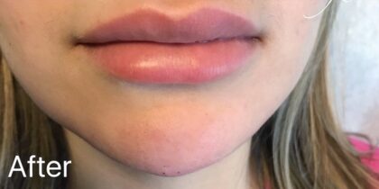 Lip Injections Before & After Patient #486