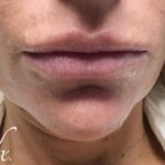 Restylane Before & After Patient #494