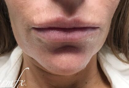 Restylane Before & After Patient #494