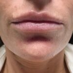 Restylane Before & After Patient #494