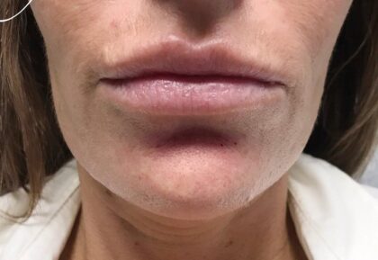 Restylane Before & After Patient #494