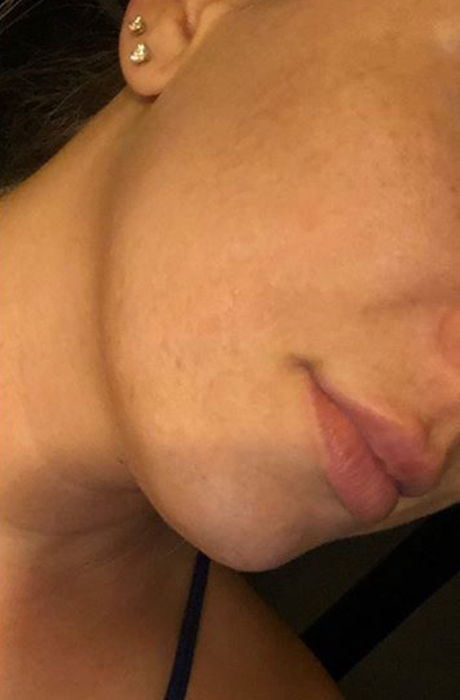 Scarlet SRF Before & After Patient #888