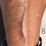 Sclerotherapy Before & After Patient #904