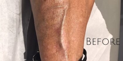 Sclerotherapy Before & After Patient #904