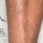 Sclerotherapy Before & After Patient #904