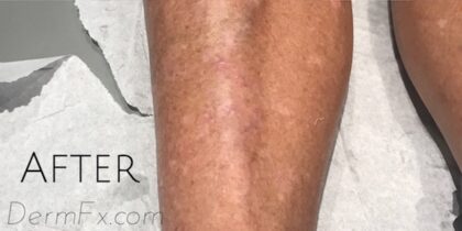 Sclerotherapy Before & After Patient #904