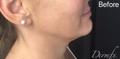 Ultherapy Before & After Patient #910