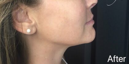 Ultherapy Before & After Patient #910