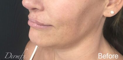 Ultherapy Before & After Patient #910