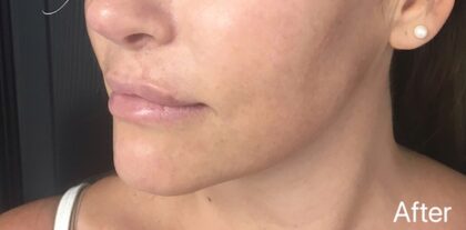 Ultherapy Before & After Patient #910