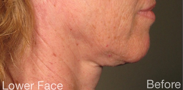 Ultherapy Before & After Patient #915