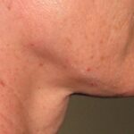 Ultherapy Before & After Patient #915