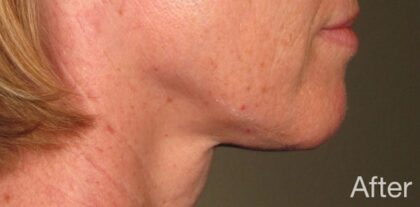 Ultherapy Before & After Patient #915