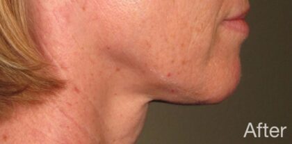 Ultherapy Before & After Patient #915