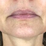 Ultherapy Before & After Patient #918
